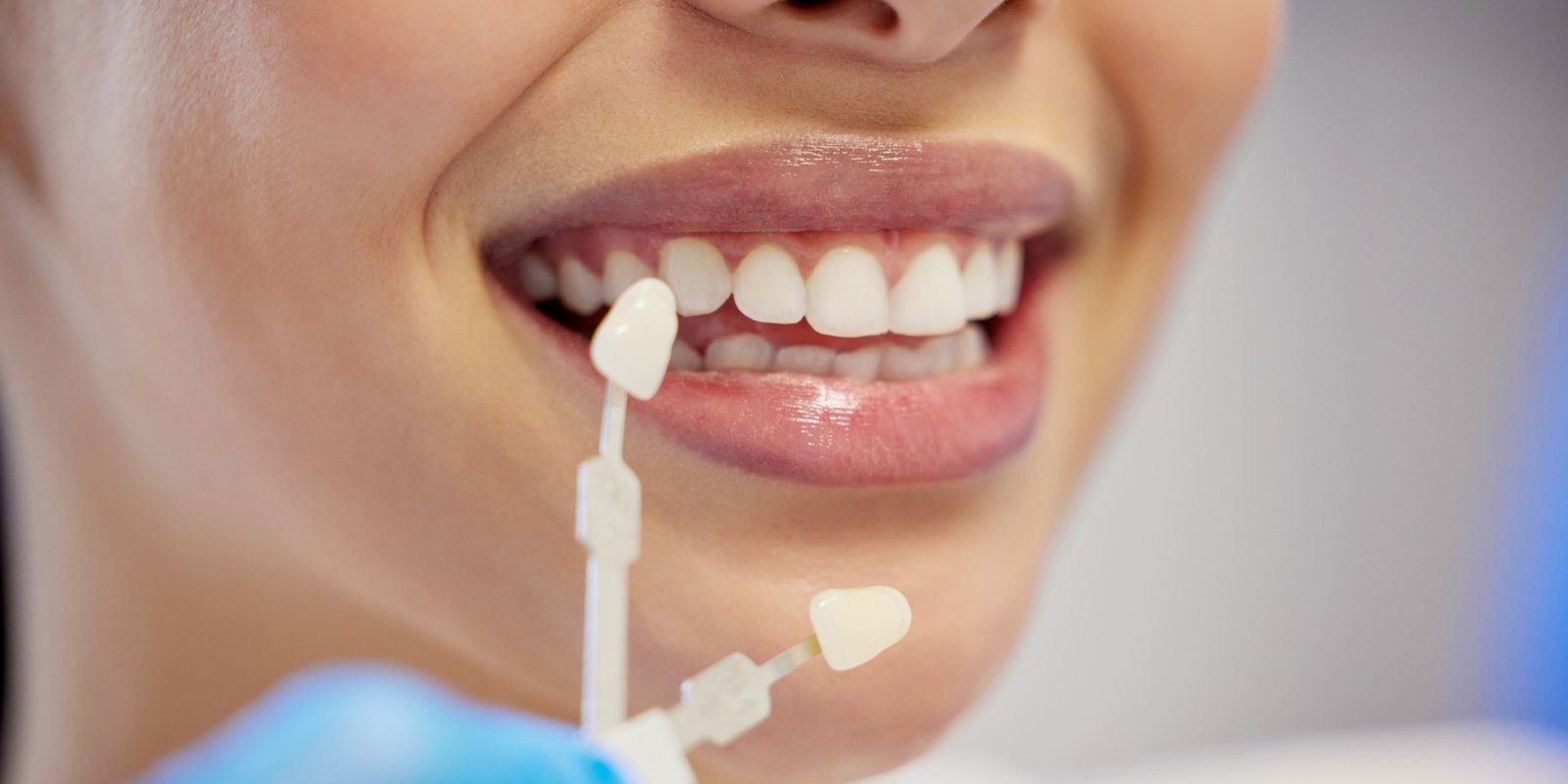 Shade guide held against a patient's smile to compare tooth color at University Dental Group in Orlando, FL