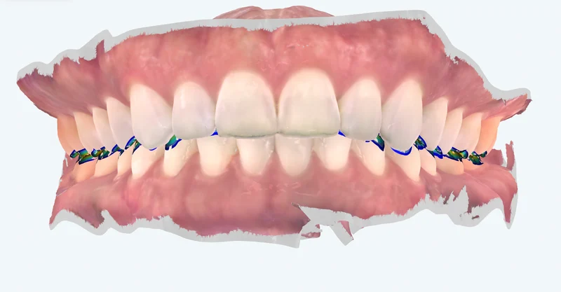 3D intraoral scan — front occlusion, University Dental Group Orlando
