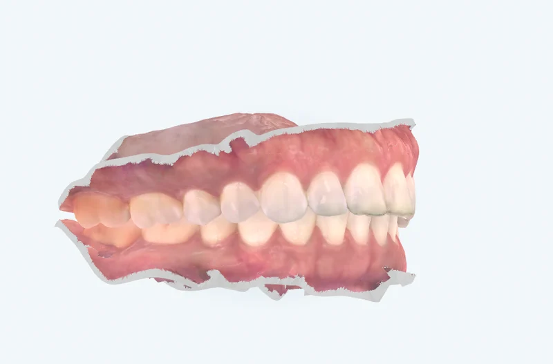 3D intraoral scan — side bite, University Dental Group Orlando