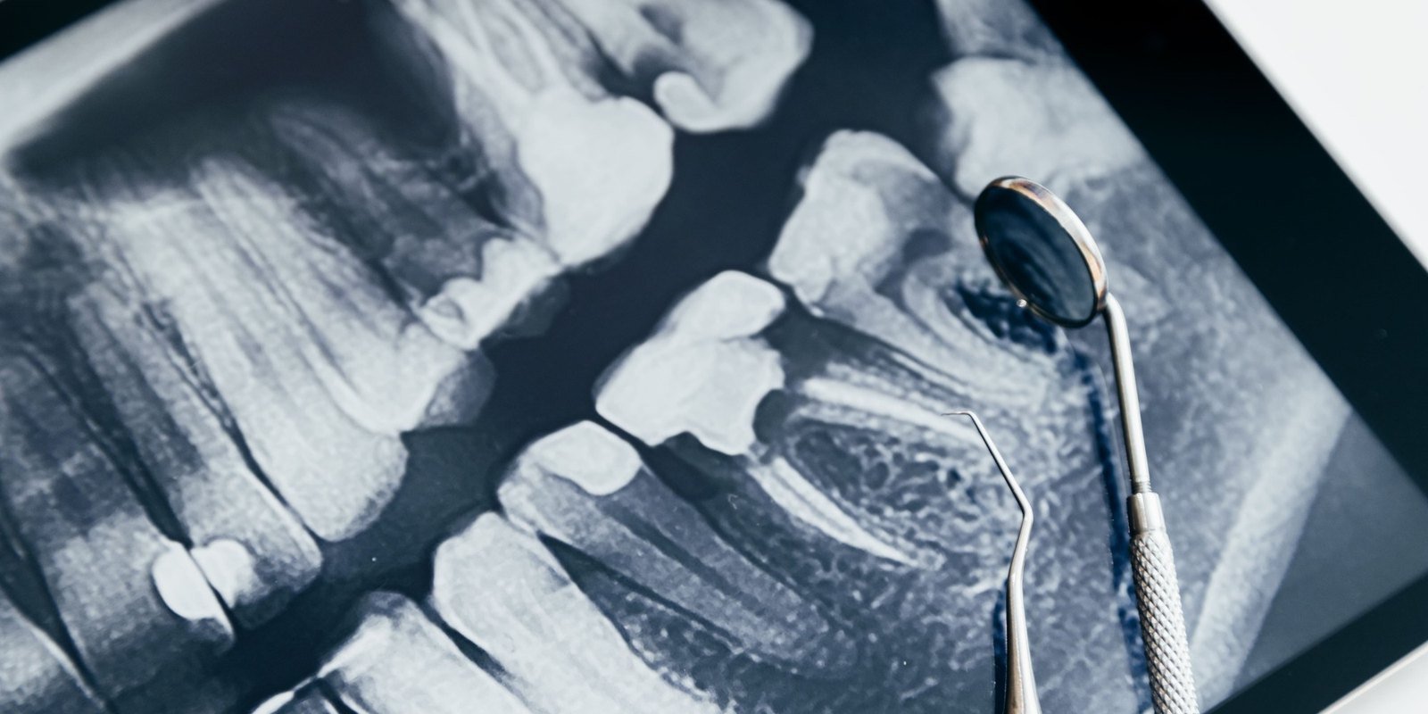 Digital dental x-ray on a tablet beside a mirror and explorer at University Dental Group in Orlando, FL