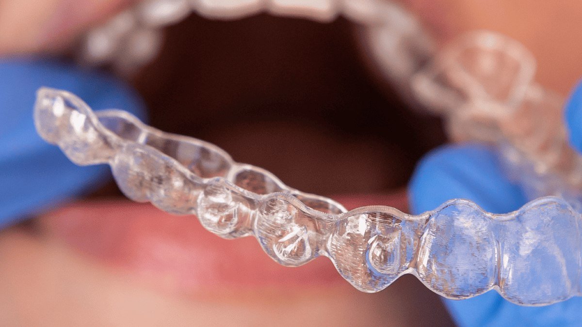 Fitting a clear Invisalign aligner at a dental visit A dentist placing a clear Invisalign aligner during a patient's orthodontic visit