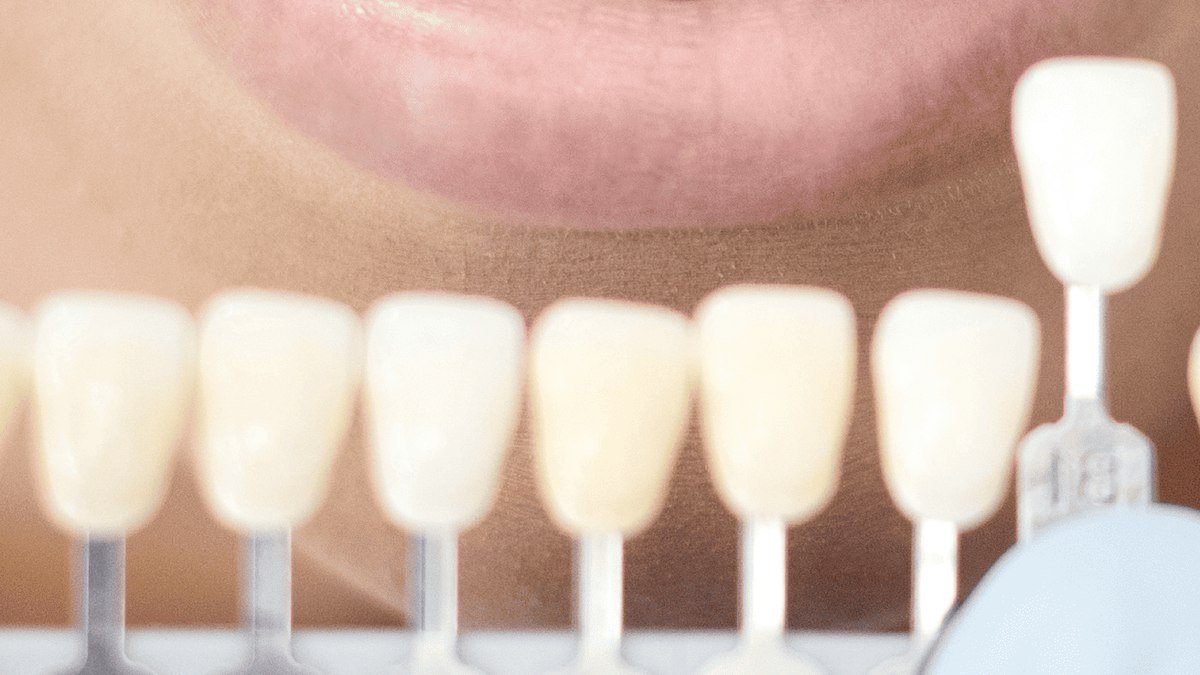 Matching a porcelain veneer shade to natural teeth Matching a porcelain veneer shade guide to a patient's natural teeth