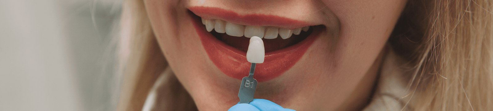 Dental professional comparing a tooth shade guide against a patient's smile before whitening in Orlando