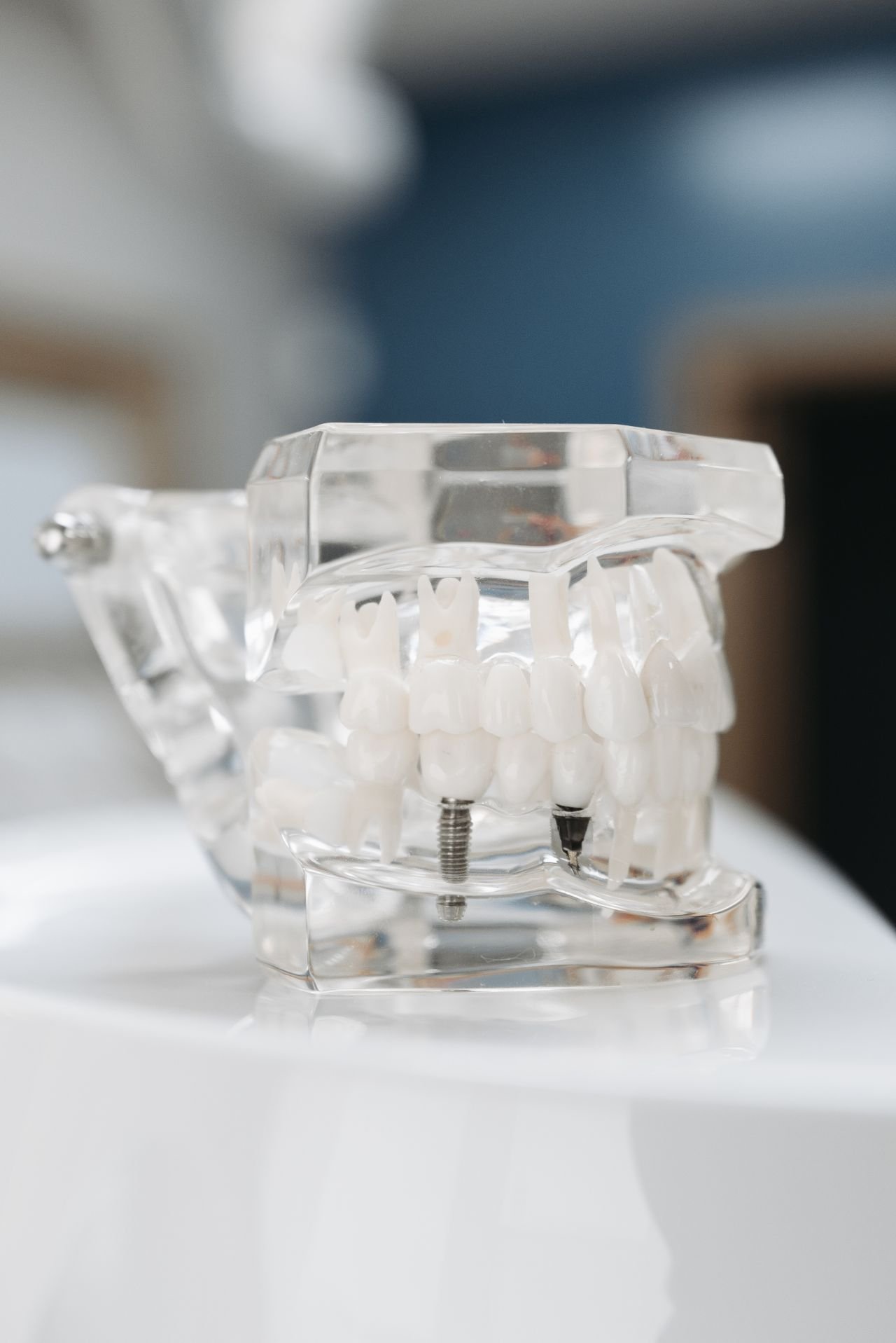 A dental implant model showing how implants anchor