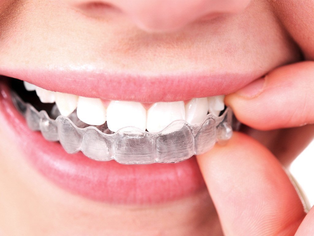 Placing a clear aligner for discreet teeth straightening